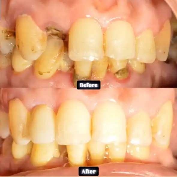 Couronnes dentaires à Rabat — avant / après sur des dents antérieures délabrées, Dr. Benabdelkrim