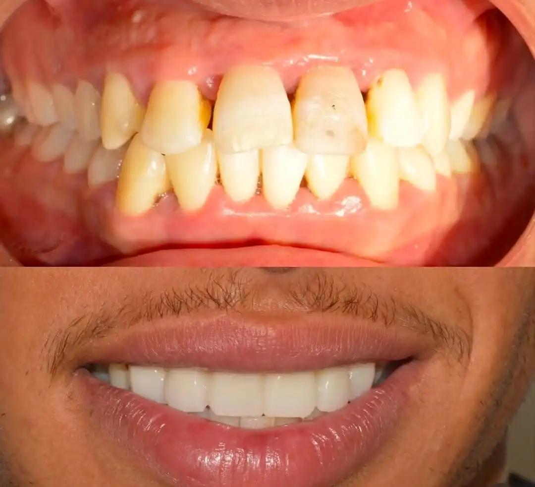 Couronnes céramique sur les dents de devant à Rabat — avant / après