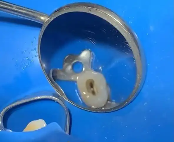 Accès canalaire vu au miroir, dent isolée sous digue dentaire — Rabat, Dr. Benabdelkrim