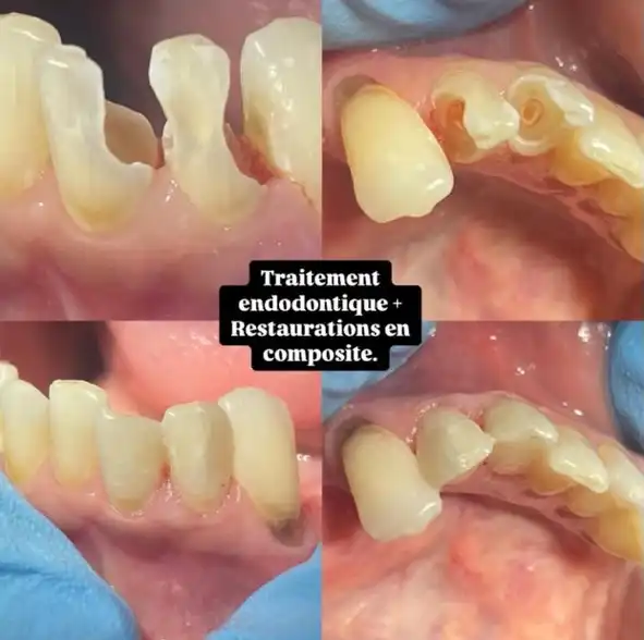 Traitement endodontique et restaurations en composite à Rabat — avant / après, Dr. Benabdelkrim