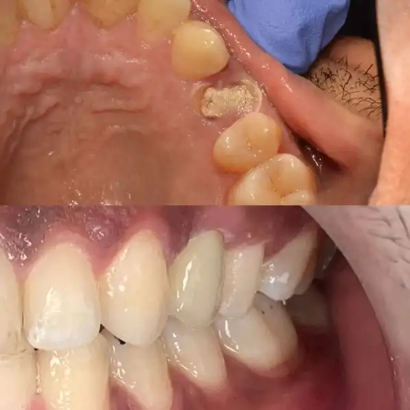 Dent dévitalisée reconstituée par tenon fibré puis couronne en zircone à Rabat — avant / après
