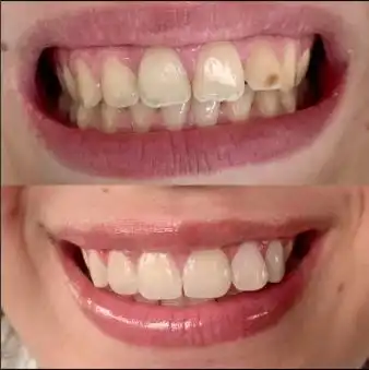 Esthétique dentaire à Rabat — avant / après, sourire éclairci et harmonisé, Dr. Benabdelkrim