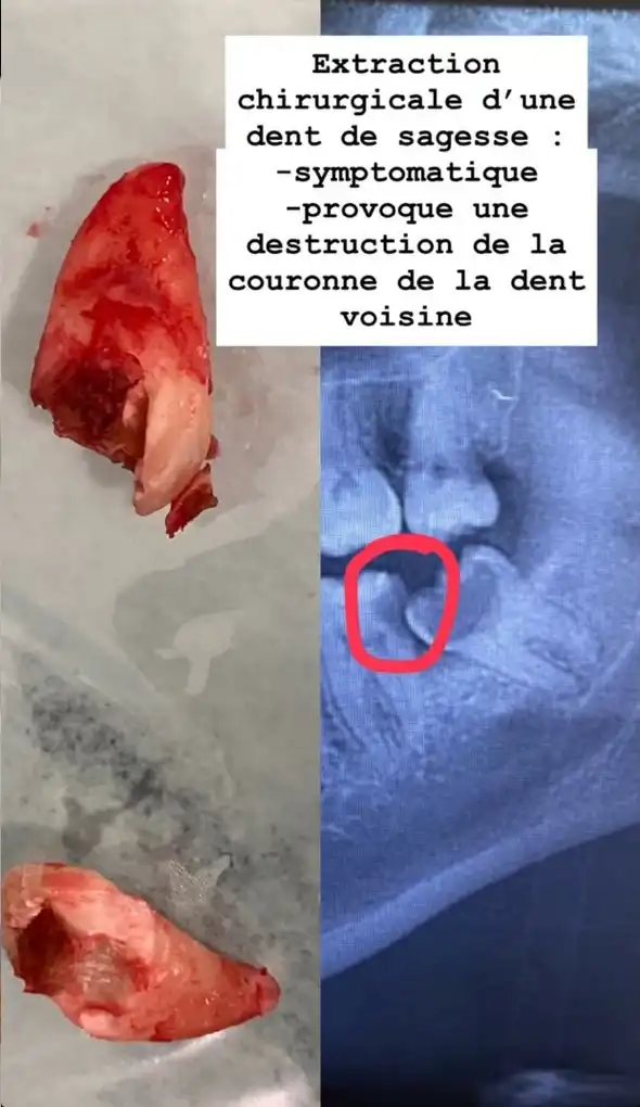 Extraction chirurgicale d'une dent de sagesse symptomatique ayant détruit la couronne de la dent voisine — Rabat, Dr. Benabdelkrim