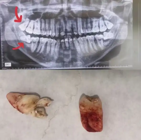 Radiographie panoramique avant l'extraction de deux dents de sagesse à Rabat — Dr. Benabdelkrim