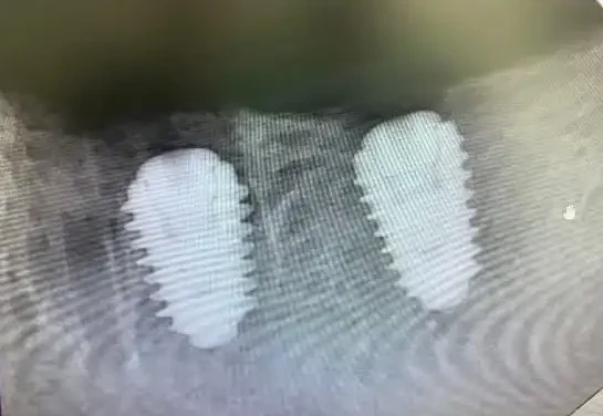 Radiographie de contrôle de deux implants dentaires posés au Cabinet Dentaire Dr. Benabdelkrim à Rabat
