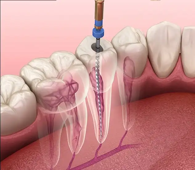 Endodontie traitement de canal Rabat