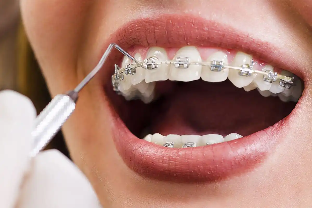 Orthodontie bagues Rabat