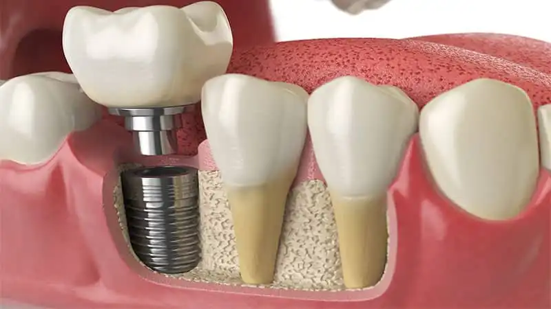 Implant dentaire Rabat