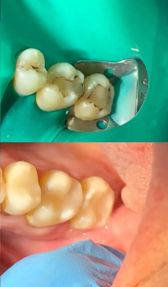 Soin de caries sous digue et restaurations en composite à Rabat — avant / après