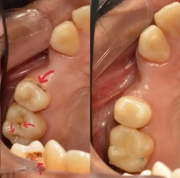 Soins de caries occlusales et proximales à Rabat — avant / après