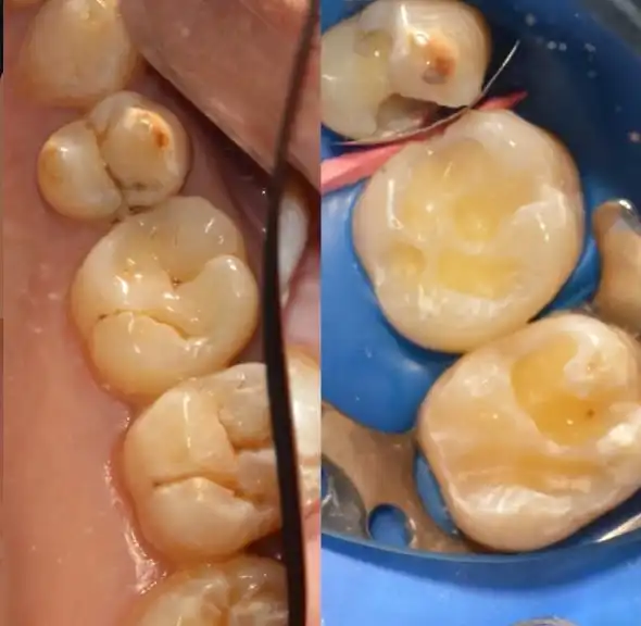 Soins de caries sous digue dentaire à Rabat — avant / après